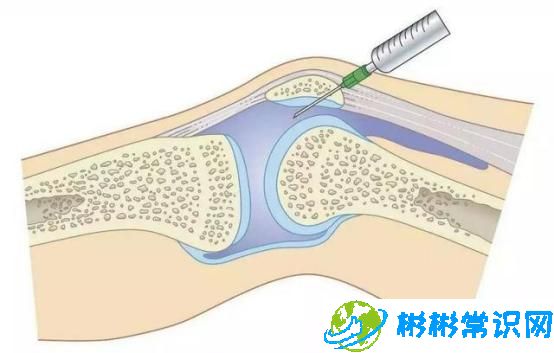 小孩膝关节积液是什么造成的