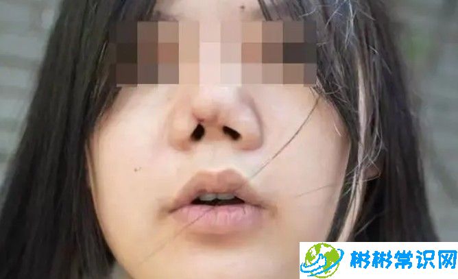 美女隆鼻后像猪鼻子，协商不成将走司法途径