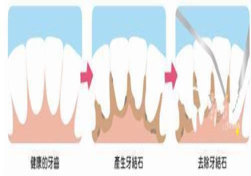 去医院洗牙对牙齿有影响吗？(洗牙会不会对牙齿不好)